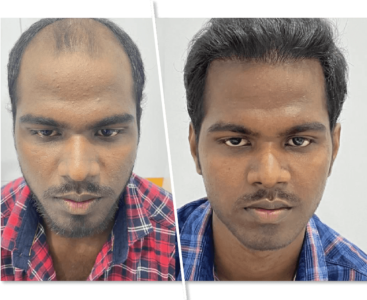 imgi_2_Hair-Transplantation_1-367x300-1.png