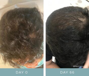 imgi_3_Hair-Loss-Aswain-BA-1024x870-1-353x300-1.jpg