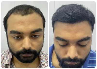imgi_7_prp-hair-treatment-before-after-3-400x286-1.webp